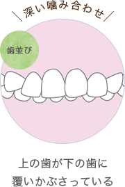 上の歯が下の歯に覆いかぶさっている